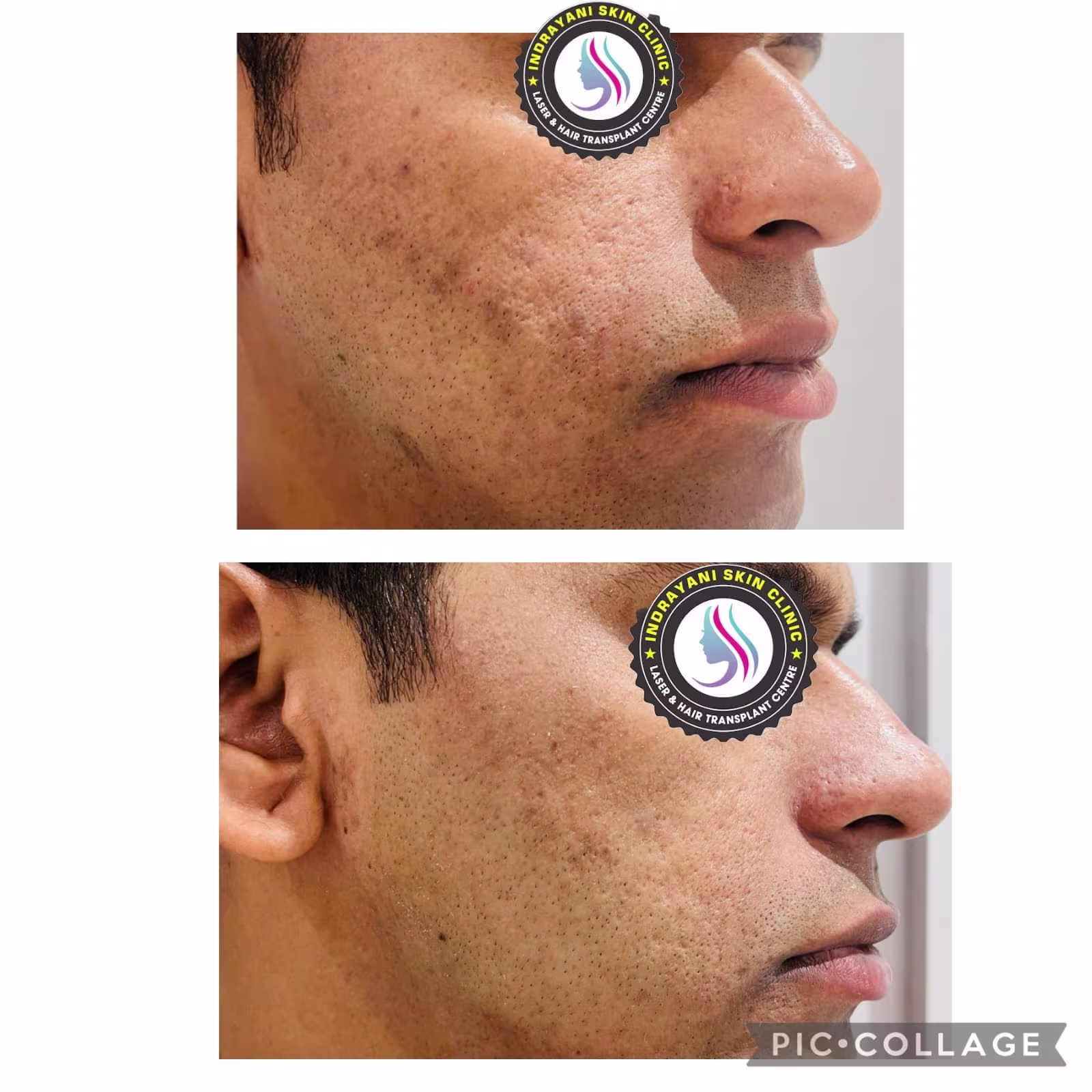 inrayani-skin-clinic-results
